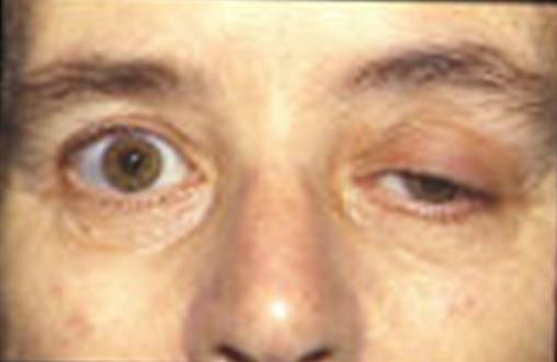 Ptosis of the left eye